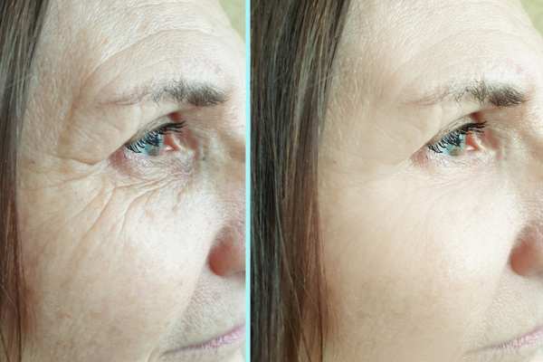 Why Do People Choose HIFU for a Non-Surgical Facelift? 4 How long can HIFU results last Allerton?