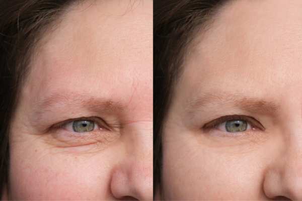 HIFU vs Botulinum Toxin: Understanding the Differences 4 How long do HIFU results last Allerton?